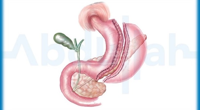 Gastrik Bypass Ameliyatı: Yeni Bir Başlangıç İçin Cesaret Veren Adım