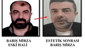 Barış Mirza, ameliyatla yüzünü değiştirmiş